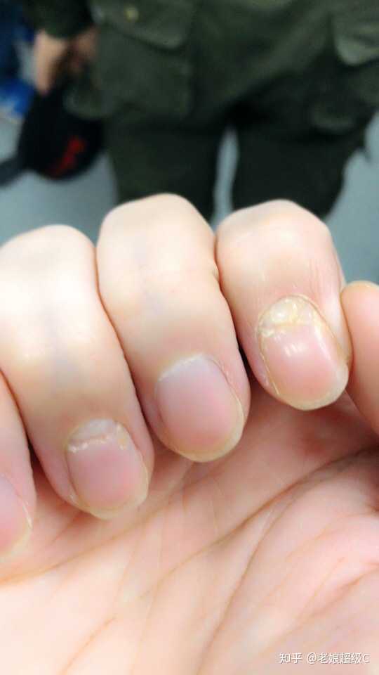 手指湿疹导致指甲变形然后烂掉了?