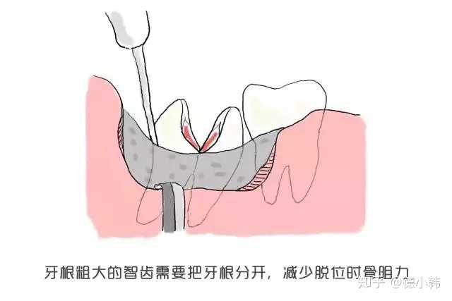 拔智齿就这么愉快的结束啦