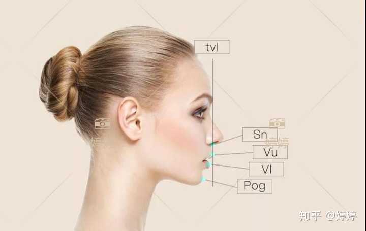 经鼻下点sn做一垂线tvl,测量颏前点pog到该垂线的距离.