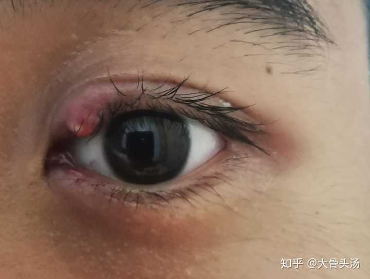 就是在下方麦粒肿好的差不多的时候,突然上方又冒出来一个(是的都是