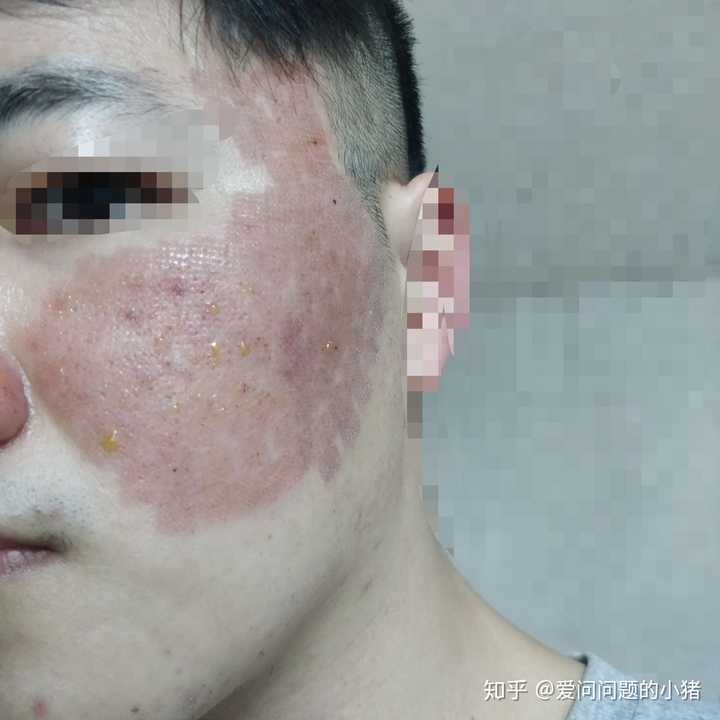 回家后,记录一下,脸上出现黄色的东西,貌似是组织液渗出来了.