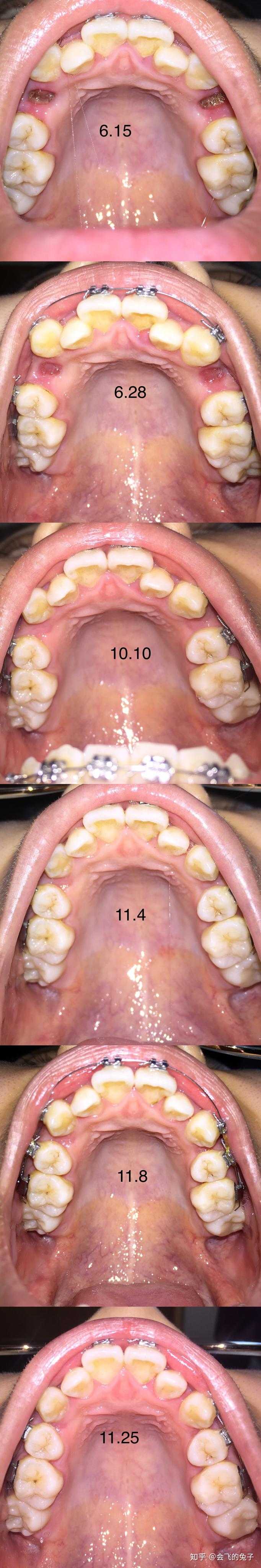 大龄男女青年牙齿正畸并拔牙的过程感觉