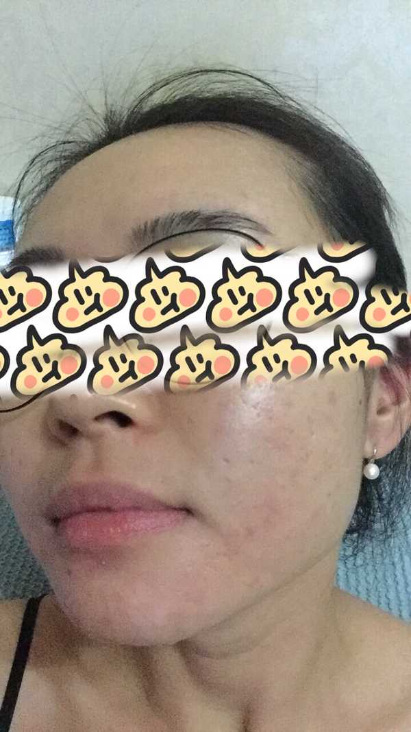 刷酸去医院好还是自己刷好呢?