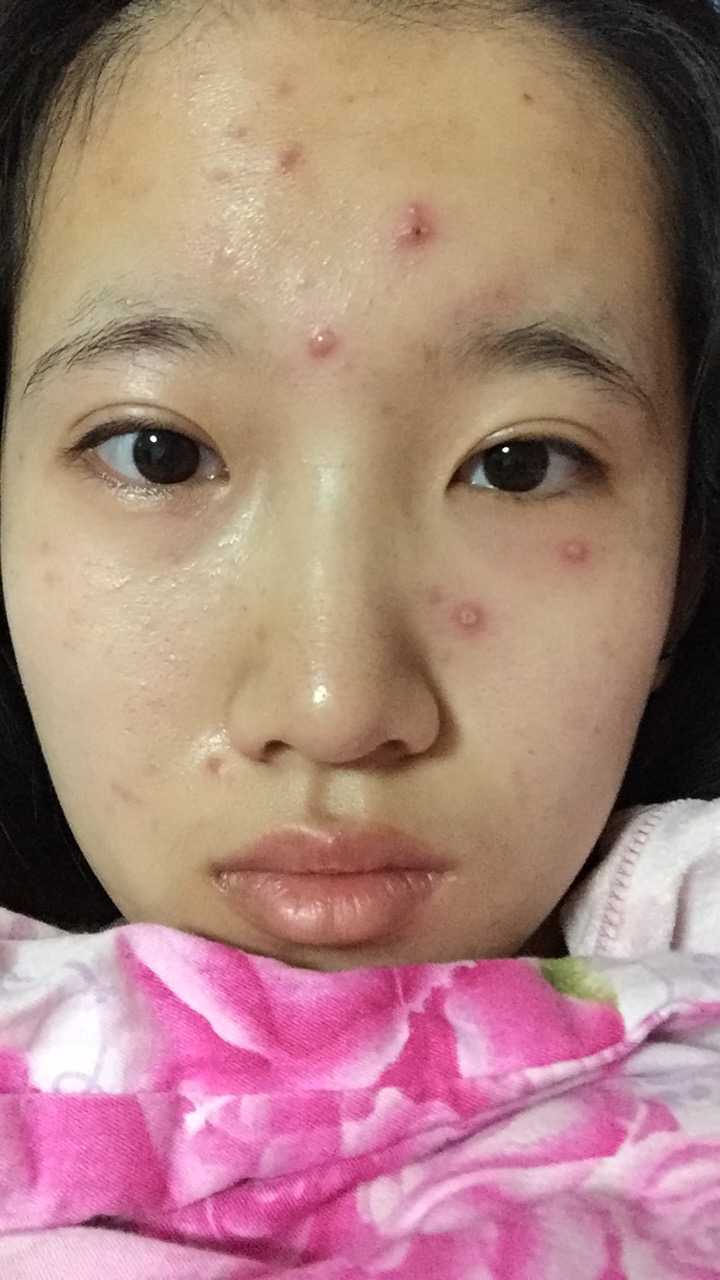 长水痘是一种怎么样的体验?