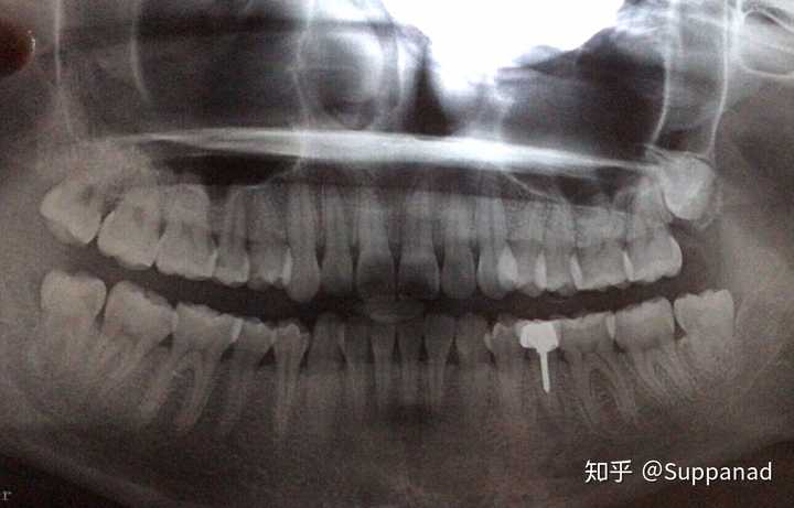 三个月前我去拔智齿时候拍的牙片,能清楚看到我的假牙