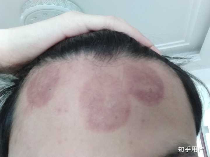 额头可以拔罐吗?