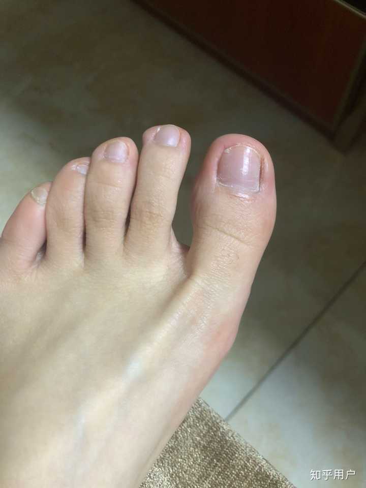 是灰指甲吗?请问怎么治疗 要涂什么药膏?