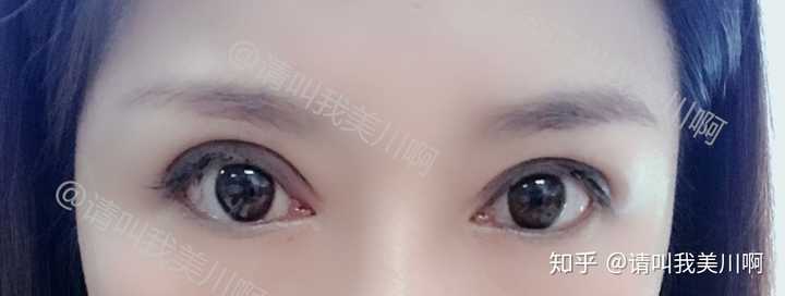 我想知道太原有哪些比较好的割双眼皮的医院,比较自然