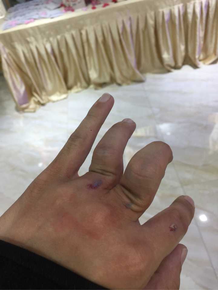 手指头骨折是种怎样的体验?