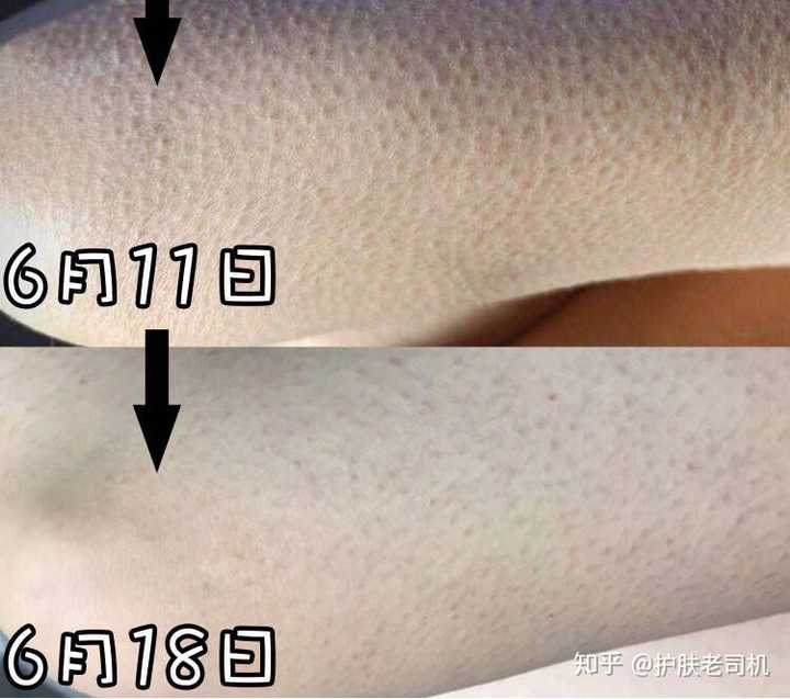 鸡皮肤怎么去除?