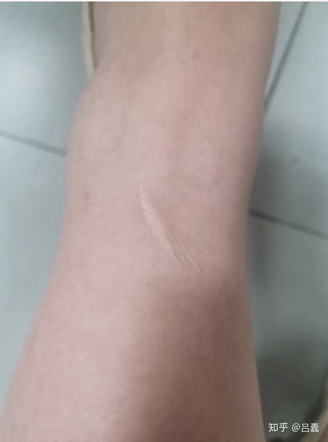 这是我腿上留下来的疤,已经超过12年了.