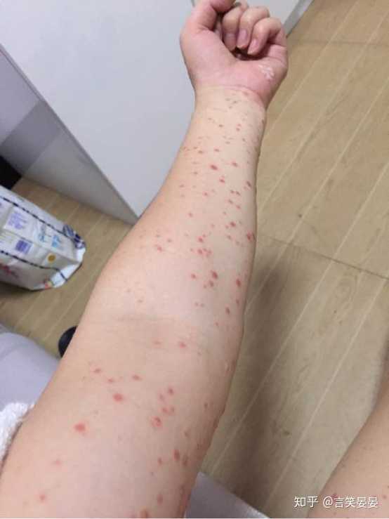 银屑病该生孩子吗?
