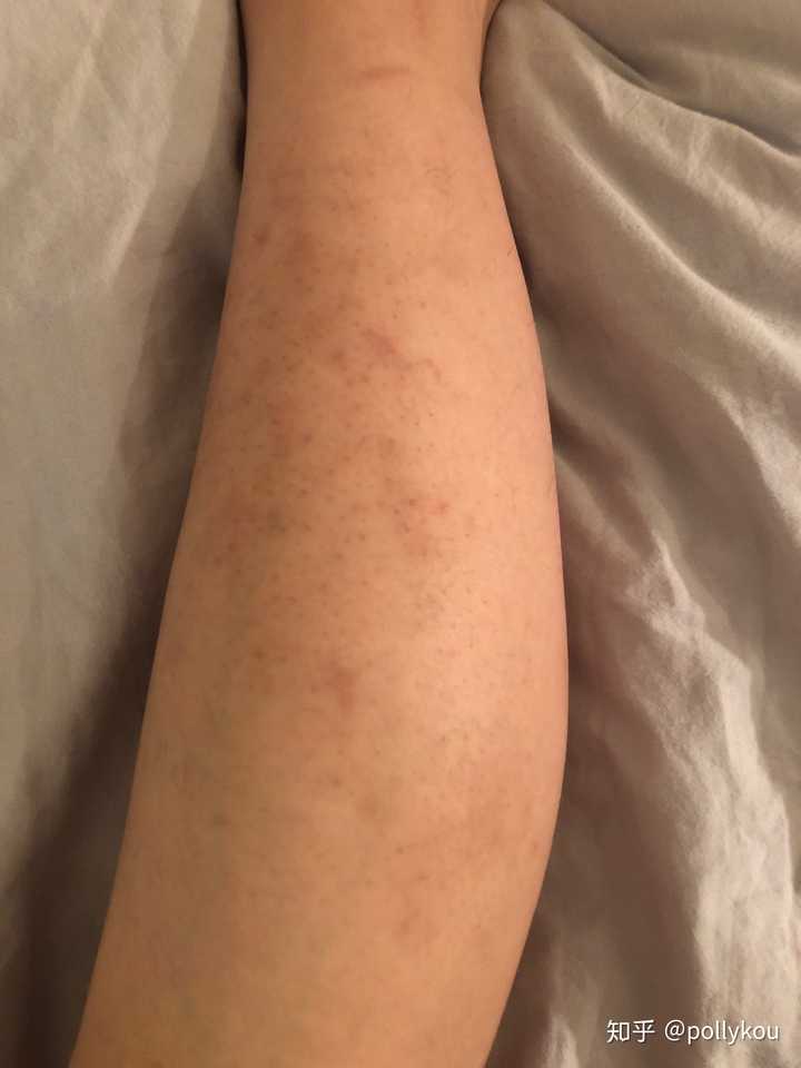 小腿特别痒,持续了两个月了,一直不好,越挠越痒挠破皮结了一腿的疤?