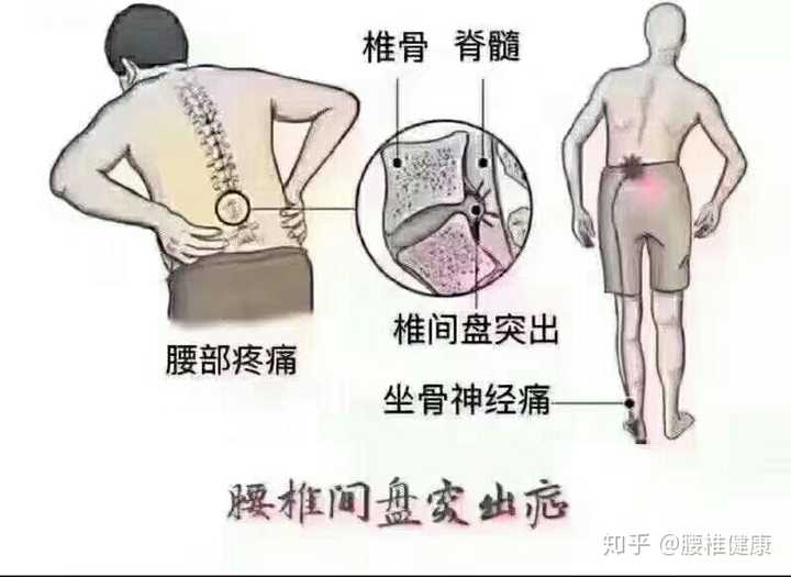 年轻人出现腰椎间盘突出的这种疾病以后,建议通过内调的方式调理髓核