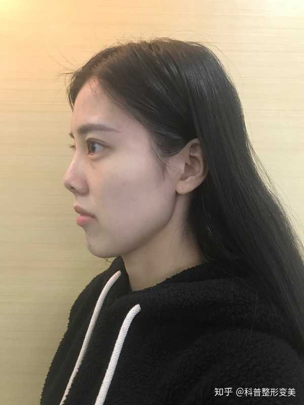 术前侧面照片