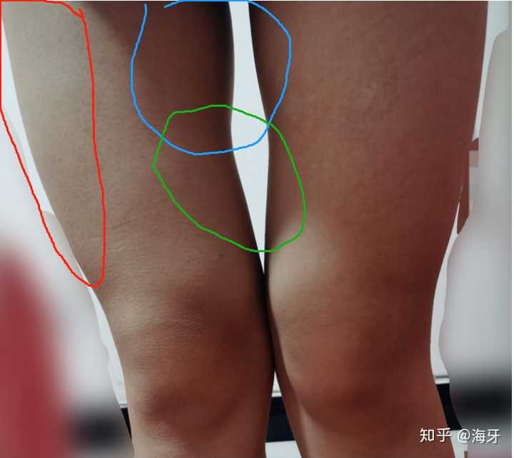 大腿外侧突出的部分,股外侧肌参与你日常的蹲起动作,内收肌群发达,股