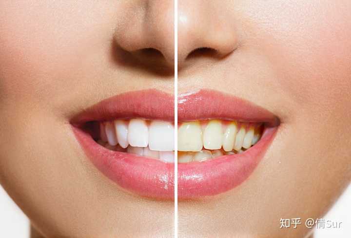 左为牙齿美白,右为正常颜色牙齿