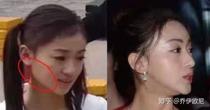 整容手术中,削骨跟磨骨有什么区别?价钱多少?多长时间恢复?