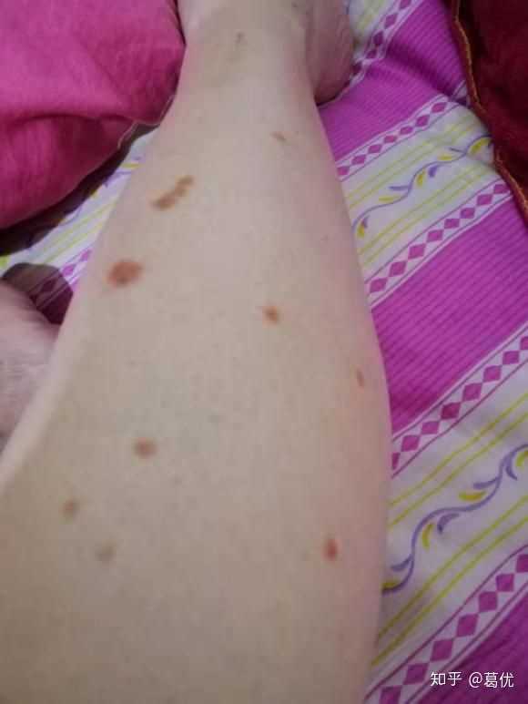 医师说这是银屑病