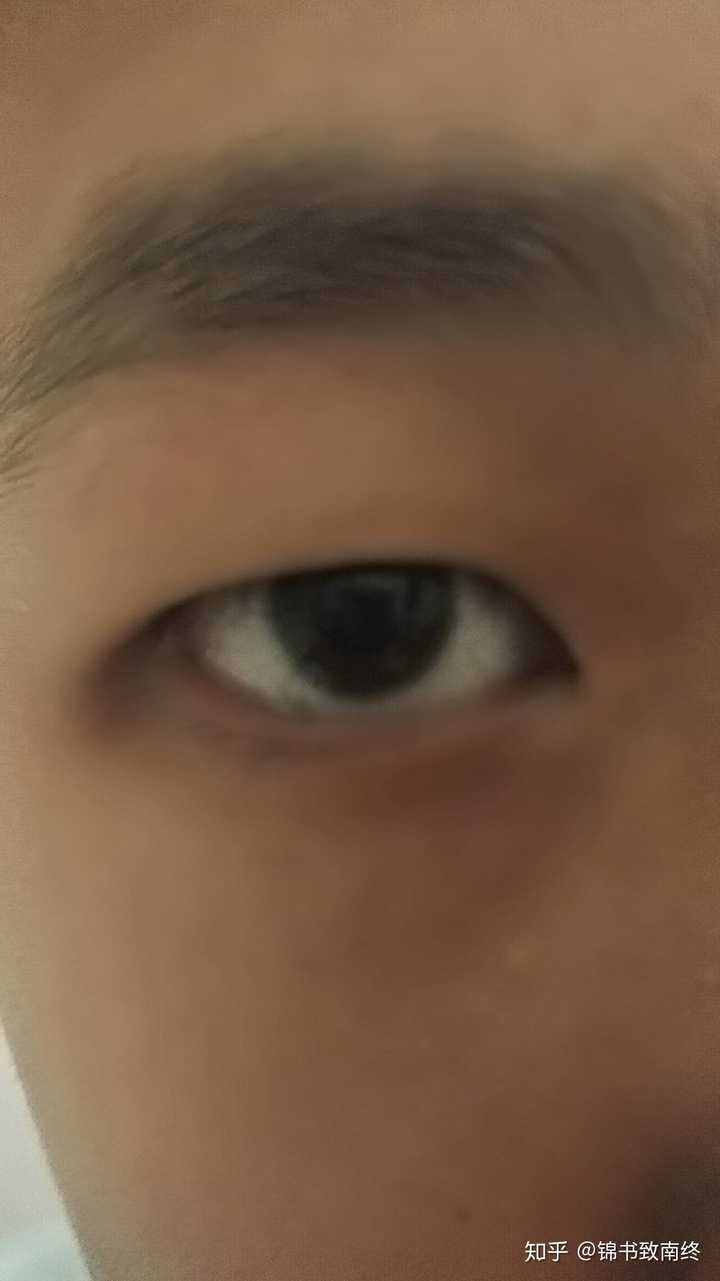 两只眼睛度数差太多会导致"大小眼"的出现么?