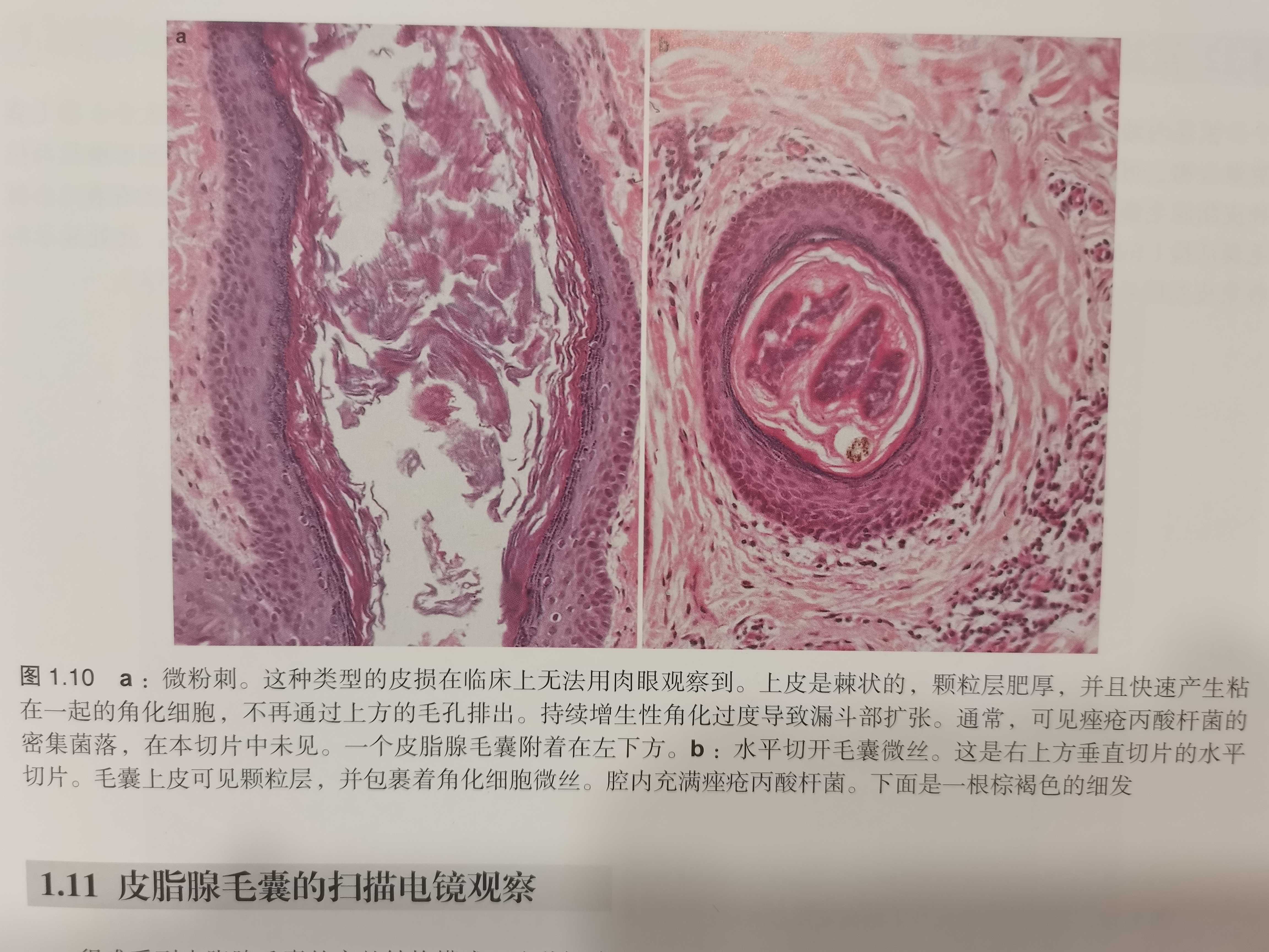 皮肤科医生严后友 的想法: 毛囊皮脂腺导管上皮角化