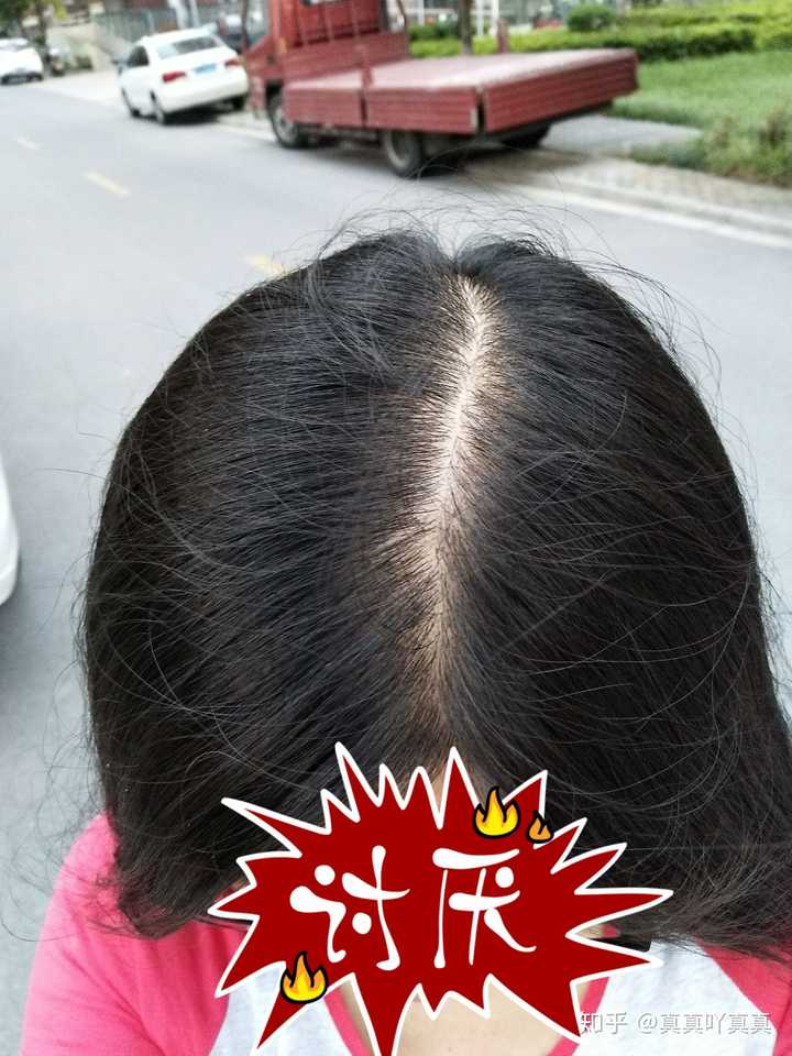 你问我熬夜脱不脱发?四个字:亲测,会秃.