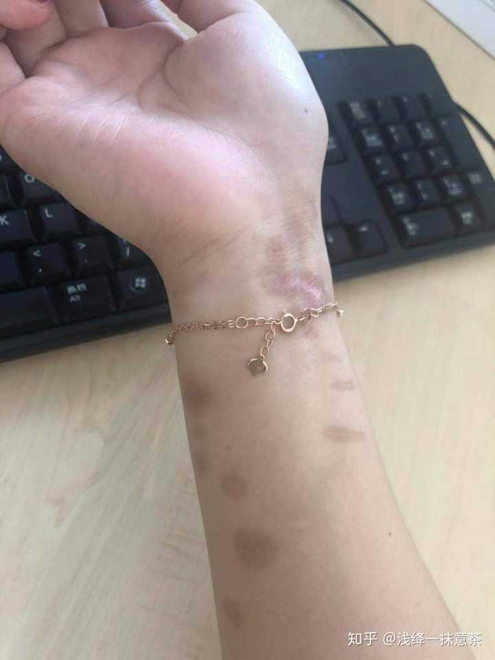 然后,手受伤的那天,我发了个朋友圈,内容如下