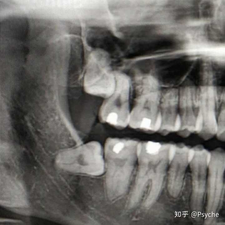 右下八号牙(拔前),拔后没拍片