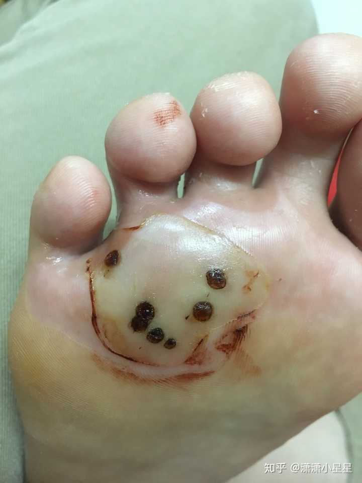 跖疣怎么治?