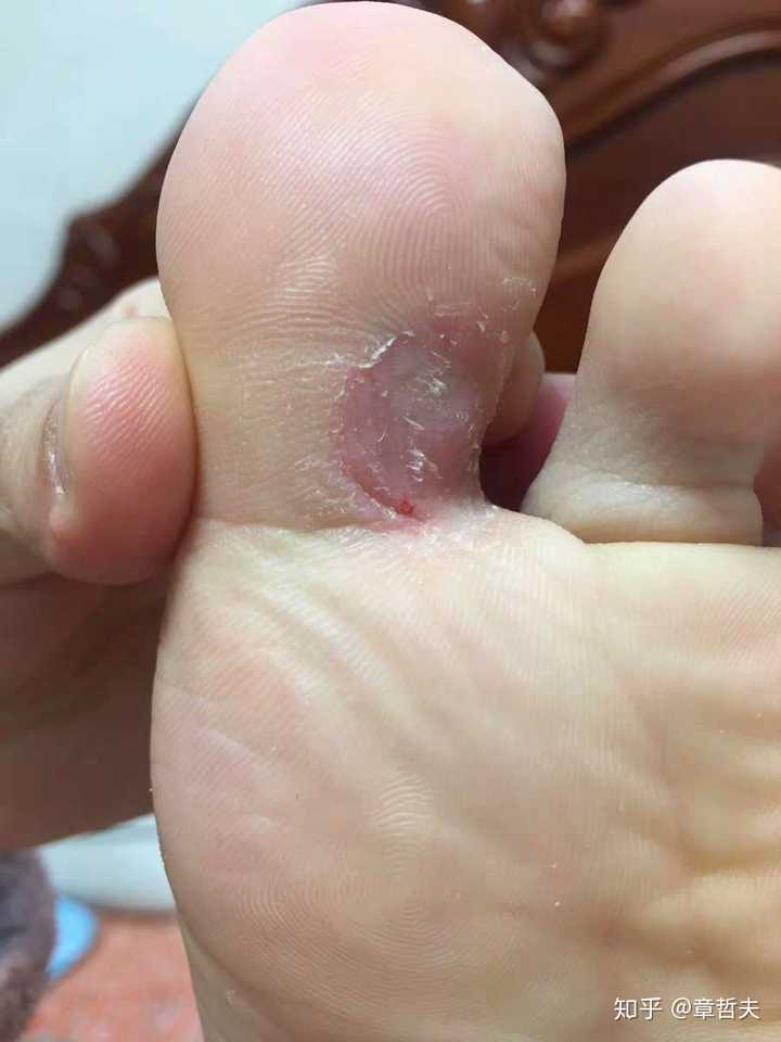 如何治疗鸡眼?