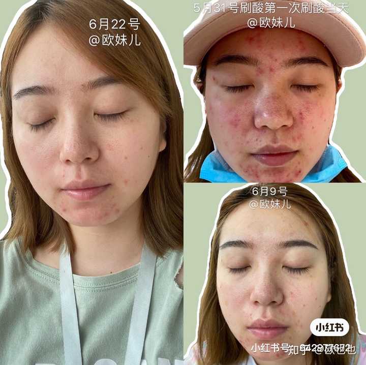 收缩毛孔的医美要持续做吗?