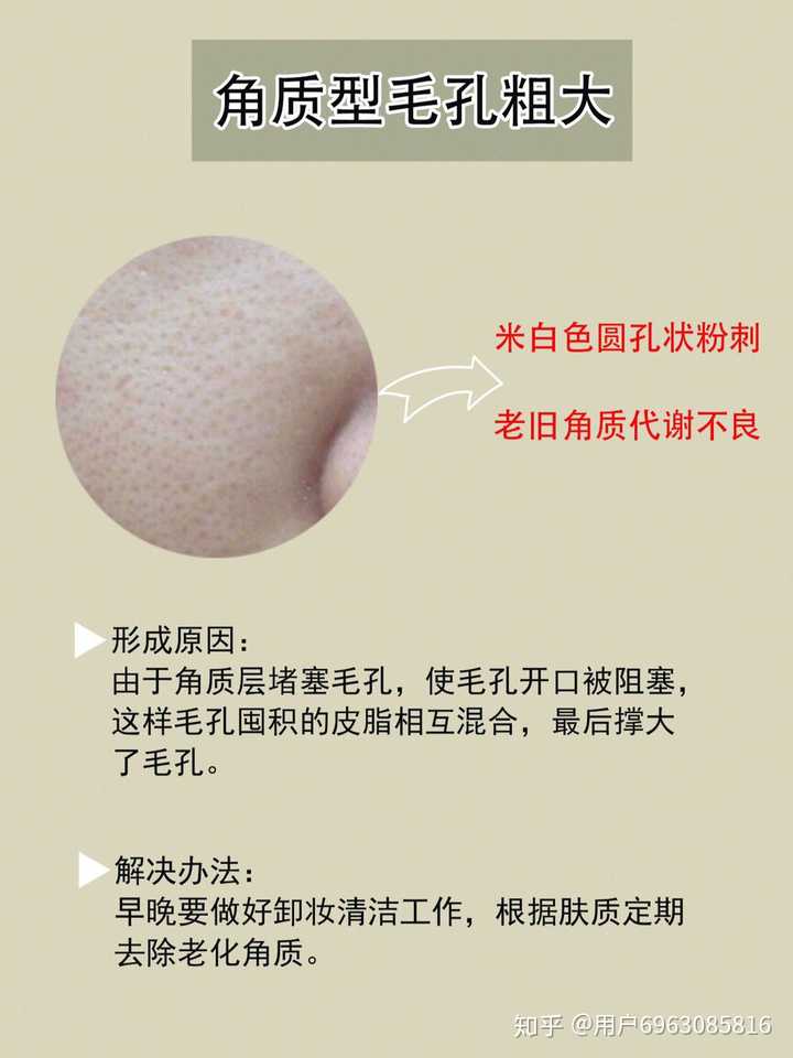很多小仙女都有毛孔粗大的问题,平时经常熬夜,清洁不彻底,挤痘痘等等