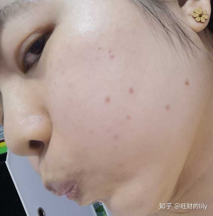 点痣有必要吗?