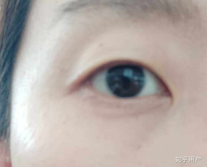 需要多久?你是什么时候变成双眼皮的呢?有什么方法促进变双?