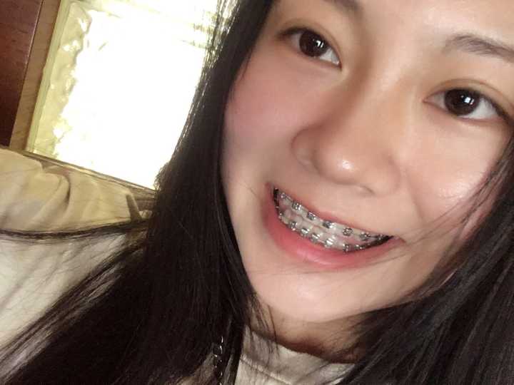 牙齿地包天兜齿是怎样的一种体验