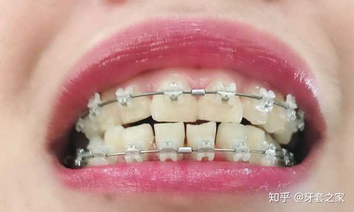 牙套需要带两年是什么体验,怕被人嫌弃?