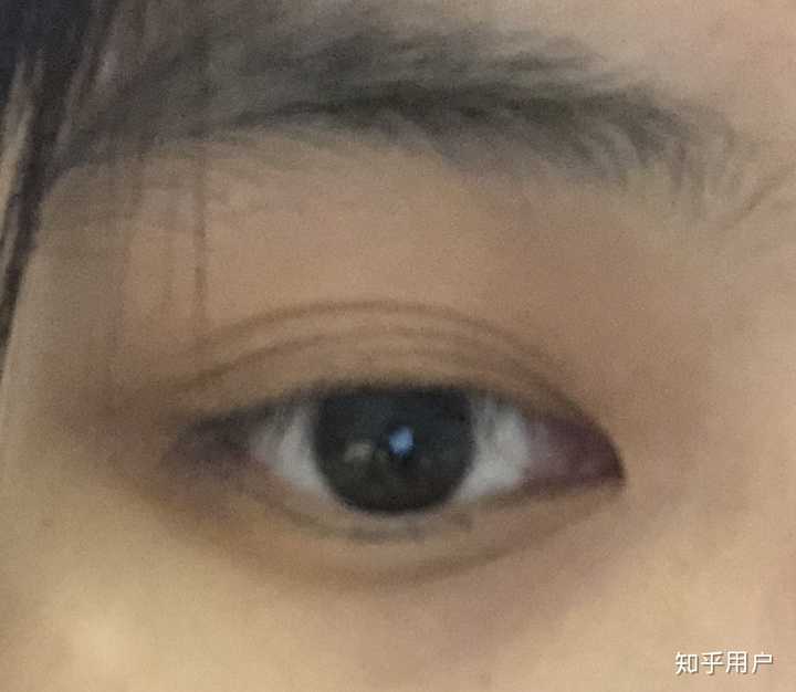 有三眼皮或多眼皮是什么体验?