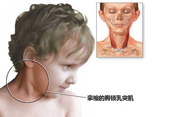 胸锁乳突肌,一端连着耳朵后方凸起的骨头,另一端连着胸骨和锁骨.