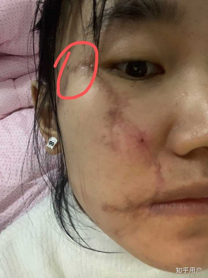 女生脸上有疤是怎样的体验?