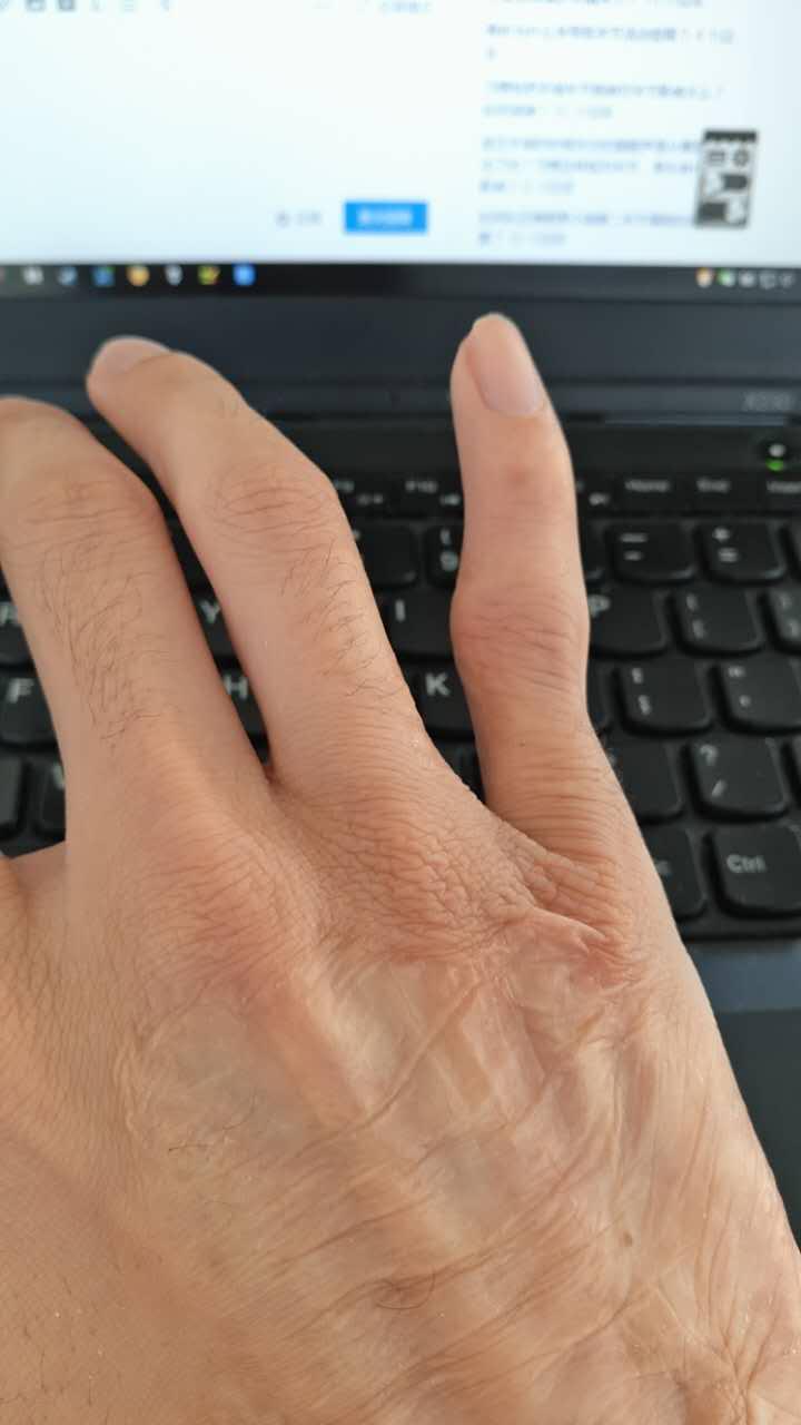 握笔姿势如何改变右手食指关节曾经断过?