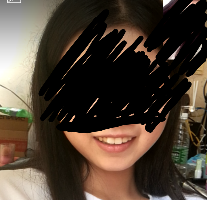 女生矫正牙齿后变美是怎样的体验?