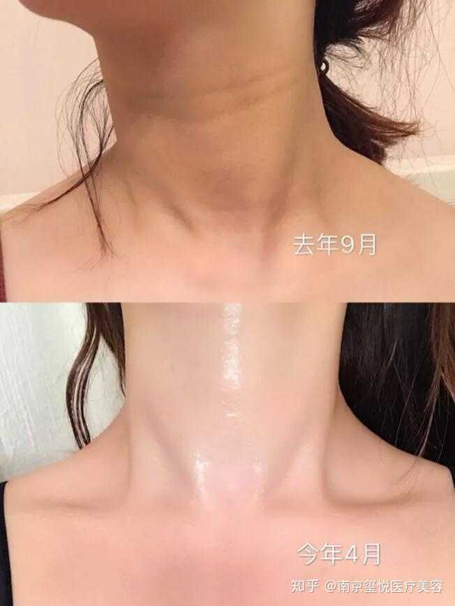 颈纹能让人瞬间老十岁?
