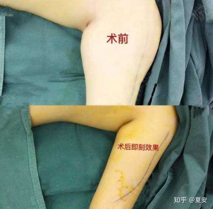 但是技术不够的医生做出来就真的惨不忍睹,甚至留下后遗症