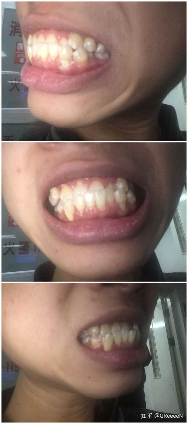 牙齿地包天(兜齿)是怎样的一种体验?