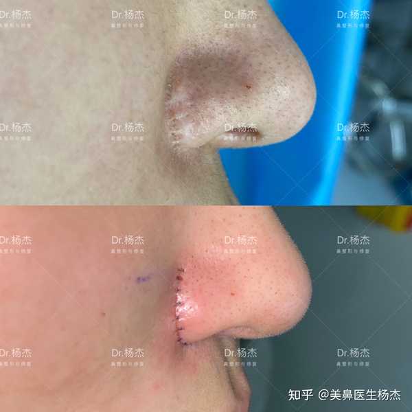 1.鼻翼鼻面沟上1mm处遗留的增生性疤痕,右侧较重; 2.