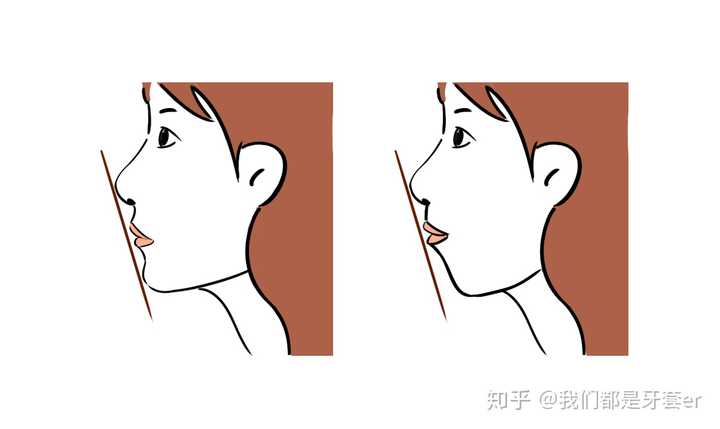 口呼吸面容会有什么特征