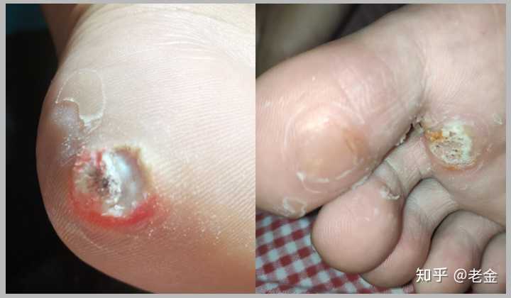 几个月没看好的跖疣到大医院花了216元涂一天药就有效果是什么体验