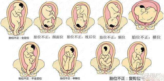 关于胎位,头在下,枕前位就是正常的 上周