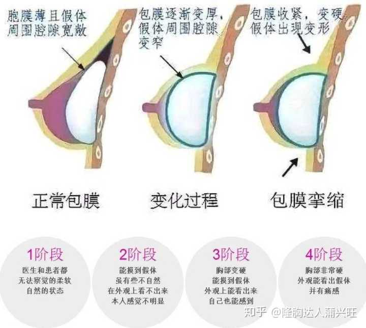 光面>毛面 包膜挛缩多是由于身材对所植入的乳房假体不接受而产生的一