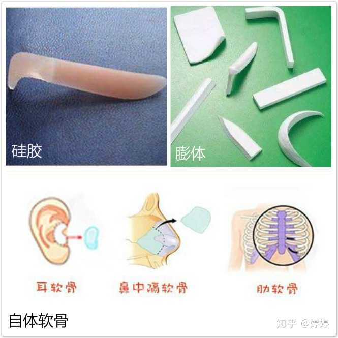 自体软骨里有耳软骨,鼻中隔软骨,自体肋软骨